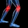 New Study: Weight Loss Surgery & Joint Replacement knee illustration